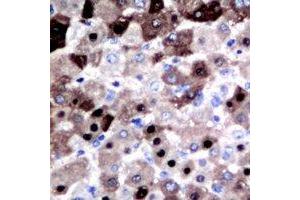 Immunohistochemical analysis of DGK iota staining in human liver cancer formalin fixed paraffin embedded tissue section. (DGKI anticorps  (C-Term))
