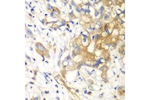 Immunohistochemistry of paraffin-embedded human liver cancer using KLK10 antibody (ABIN6290548) at dilution of 1:100 (40x lens).