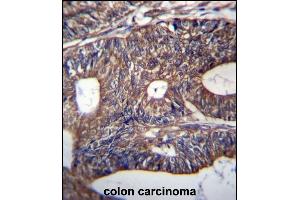 UQCRB Antibody (Center) (ABIN656932 and ABIN2846122) immunohistochemistry analysis in formalin fixed and paraffin embedded human colon carcinoma followed by peroxidase conjugation of the secondary antibody and DAB staining.