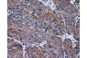 Immunohistochemical staining of paraffin-embedded Adenocarcinoma of colon tissue using anti-RALBP1 mouse monoclonal antibody. (RALBP1 anticorps)