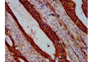 IHC image of ABIN7175679 diluted at 1:500 and staining in paraffin-embedded human colon cancer performed on a Leica BondTM system. (WIPF2 anticorps  (AA 18-176))