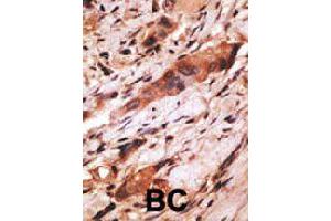 Formalin-fixed and paraffin-embedded human cancer tissue reacted with CD82 polyclonal antibody  , which was peroxidase-conjugated to the secondary antibody, followed by AEC staining. (CD82 anticorps  (C-Term))