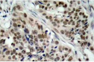Immunohistochemistry (IHC) analyzes of p-FoxO1 antibody in paraffin-embedded human breast carcinoma tissue. (FOXO1 anticorps  (pSer256))