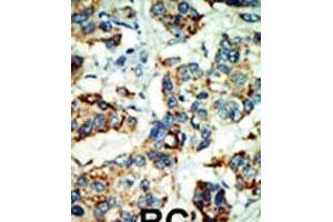 Formalin-fixed and paraffin-embedded human cancer tissue reacted with the primary antibody, which was peroxidase-conjugated to the secondary antibody, followed by AEC staining.