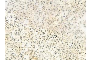 ABIN6263588 and ABIN6279411 at 1/100 staining human Hodgkin lymphoma by IHC-P. (NEIL2 anticorps  (Internal Region))