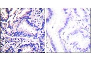 Immunohistochemistry analysis of paraffin-embedded human lung carcinoma tissue, using Synuclein gamma Antibody. (SNCG anticorps  (AA 78-127))
