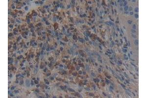 Detection of CAP2 in Human Lung cancer Tissue using Polyclonal Antibody to Adenylyl Cyclase Associated Protein 2 (CAP2)