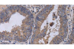 Immunohistochemistry of paraffin-embedded Human colon cancer tissue using MKKS Polyclonal Antibody at dilution 1:50 (MKKS anticorps)