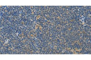 Immunohistochemistry of paraffin-embedded Human lymphoma using ASPA Polyclonal Antibody at dilution of 1:80 (ASPA anticorps)