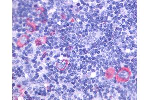 Anti-GPR137 antibody IHC of human Lymph Node, Hodgkins Lymphoma. (GPR137 anticorps  (Extracellular Domain))