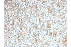 Formalin-fixed, paraffin-embedded human Lung SCC stained with PD-L1-Monospecific Mouse Monoclonal Antibody (PDL1/2746).