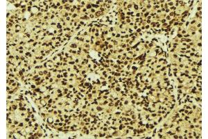 ABIN6277246 at 1/100 staining Human breast cancer tissue by IHC-P. (TNK2 anticorps  (C-Term))