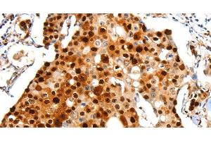 Immunohistochemistry of paraffin-embedded Human breast cancer using Proliferating Cell Nuclear Antigen Polyclonal Antibody at dilution of 1:44 (PCNA anticorps)