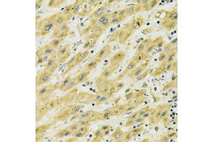 Immunohistochemistry of paraffin-embedded human liver cancer using HSPA9 antibody (ABIN5970207) at dilution of 1/100 (40x lens).