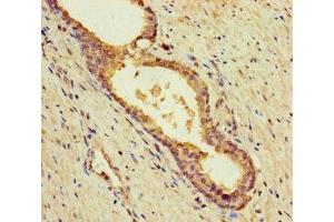 Immunohistochemistry of paraffin-embedded human prostate cancer using ABIN7145605 at dilution of 1:100 (MUTED anticorps  (AA 2-187))
