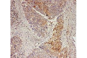 IHC-P: GRB7 antibody testing of human oesophagus squama cancer tissue (GRB7 anticorps  (Middle Region))