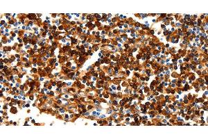 Immunohistochemistry of paraffin-embedded Human tonsil tissue using NCOR1 Polyclonal Antibody at dilution 1:100 (NCOR1 anticorps)