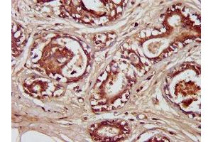 IHC image of ABIN7151723 diluted at 1:300 and staining in paraffin-embedded human breast cancer performed on a Leica BondTM system. (ENTR1 (AA 121-230) anticorps)