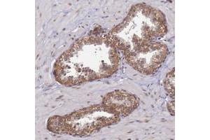 Immunohistochemical staining of human prostate with CCDC9 polyclonal antibody  shows moderate cytoplasmic positivity in glandular cells. (CCDC9 anticorps)