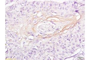 Formalin-fixed and paraffin embedded human esophageal carcinoma labeled with Anti-Integrin Alpha X/CD11c Polyclonal Antibody, Unconjugated  at 1:200 followed by conjugation to the secondary antibody and DAB staining