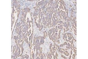 IHC analysis of Cytokeratin 19 using anti-Cytokeratin 19 antibody (ABIN3043288).