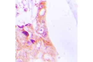 Immunohistochemical analysis of Cytokeratin 8 staining in human lung cancer formalin fixed paraffin embedded tissue section. (KRT8 anticorps  (Center))