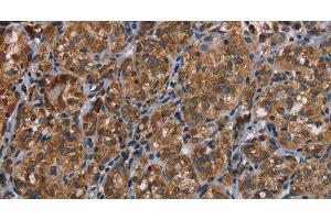 Immunohistochemistry of paraffin-embedded Human thyroid cancer tissue using LLGL1 Polyclonal Antibody at dilution 1:40
