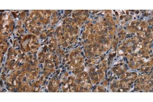Immunohistochemistry of paraffin-embedded Human thyroid cancer tissue using LLGL1 Polyclonal Antibody at dilution 1:40 (LLGL1 anticorps)