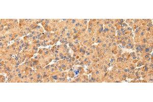 Immunohistochemistry of paraffin-embedded Human liver cancer tissue using AQP7 Polyclonal Antibody at dilution 1:40 (Aquaporin 7 anticorps)