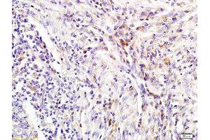 Formalin-fixed and paraffin embedded human colon carcinoma labeled with Rabbit Anti NGAL/Lipocalin 2 Polyclonal Antibody, Unconjugated (ABIN685627) at 1:200 followed by conjugation to the secondary antibody and DAB staining (Lipocalin 2 anticorps  (AA 101-198))