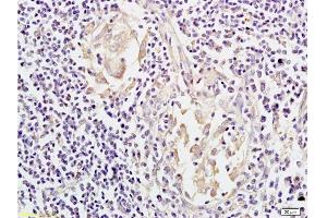 Formalin-fixed and paraffin embedded: human colon carcinoma labeled with Anti-Mesothelin Polyclonal Antibody, Unconjugated  at 1:200, followed by conjugation to the secondary antibody and DAB staining (Mesothelin anticorps  (AA 101-200))