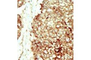 Formalin-fixed and paraffin-embedded human cancer tissue reacted with the primary antibody, which was peroxidase-conjugated to the secondary antibody, followed by DAB staining.