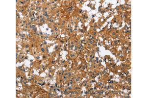 Immunohistochemistry of Human liver cancer using BGN Polyclonal Antibody at dilution of 1:50 (Biglycan anticorps)