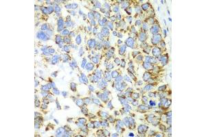 Immunohistochemistry of paraffin-embedded human esophageal cancer using CHIA antibody. (CHIA anticorps)