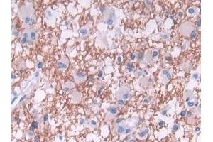 Detection of TDH in Human Glioma Tissue using Polyclonal Antibody to L-Threonine Dehydrogenase (TDH) (Tdh anticorps  (AA 1-229))