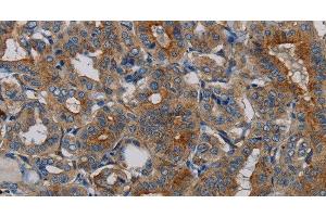 Immunohistochemistry of paraffin-embedded Human thyroid cancer tissue using PER2 Polyclonal Antibody at dilution 1:50