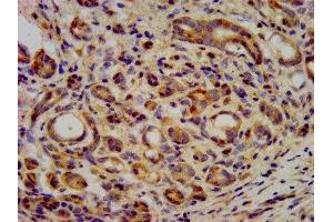 IHC image of ABIN7157616 diluted at 1:400 and staining in paraffin-embedded human pancreatic cancer performed on a Leica BondTM system. (KIF2B anticorps  (AA 1607-1731))