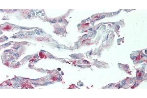 Immunohistochemistry of paraffin-embedded Human Lung tissue using SLC34A2 Polyclonal Antibody at dilution of 1:60. (SLC34A2 anticorps)