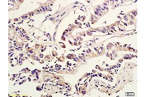Formalin-fixed and paraffin embedded human colon cancer labeled with Anti Amphiregulin Polyclonal Antibody, Unconjugated (ABIN704996) at 1:600 followed by conjugation to the secondary antibody and DAB staining (Amphiregulin anticorps  (AA 185-252))