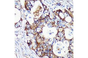 Immunohistochemistry of paraffin-embedded Human colon carcinoma using T Rabbit pAb (ABIN7266436) at dilution of 1:100 (40x lens). (TACO1 anticorps  (AA 1-297))