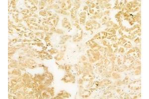 ABIN6260136 and ABIN6278425 at 1/100 staining human renal cell carcinoma by IHC-P.