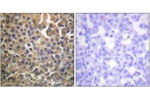 Immunohistochemistry analysis of paraffin-embedded human breast carcinoma, using HER4 (Phospho-Tyr1284) Antibody. (ERBB4 anticorps  (pTyr1284))