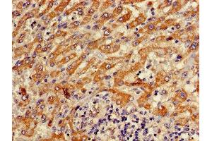 Immunohistochemistry of paraffin-embedded human liver cancer using ABIN7144848 at dilution of 1:100