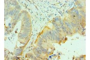 Immunohistochemistry of paraffin-embedded human colon cancer using ABIN7147105 at dilution of 1:100