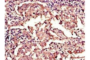 Immunohistochemistry of paraffin-embedded human lung cancer using ABIN7157854 at dilution of 1:100