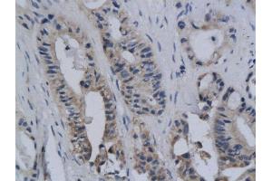 Formalin-fixed and paraffin embedded human colon cancer labeled with Anti-ROS/C ROS Polyclonal Antibody, Unconjugated  followed by conjugation to the secondary antibody