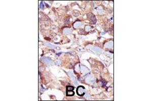 Formalin-fixed and paraffin-embedded human cancer tissue reacted with the primary antibody, which was peroxidase-conjugated to the secondary antibody, followed by DAB staining.