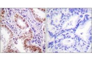 Immunohistochemistry analysis of paraffin-embedded human lung carcinoma tissue, using Histone H3 (Ab-9) Antibody. (Histone 3 anticorps  (AA 1-50))