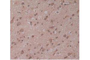 IHC-P analysis of Human Glioma Tissue, with DAB staining. (ENPP2 anticorps  (AA 637-905))
