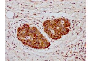 IHC image of ABIN7142105 diluted at 1:1000 and staining in paraffin-embedded human pancreatic cancer performed on a Leica BondTM system.